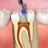 Do Root Canals Hurt, How Painful Is A Root Canal?